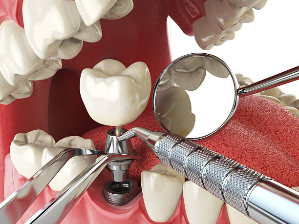 Best Emergency Treatment for Dental Infections or Abscesses in Owingsville, KY